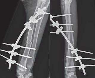 Post-operative mediolateral and craniocaudal radiographs of an open radius fracture with an applied external skeletal fixator. Such devices are excellent choices for open fracture fixation because they allow care of an open wound while preserving bone blood supply and minimizing soft tissue disruption.